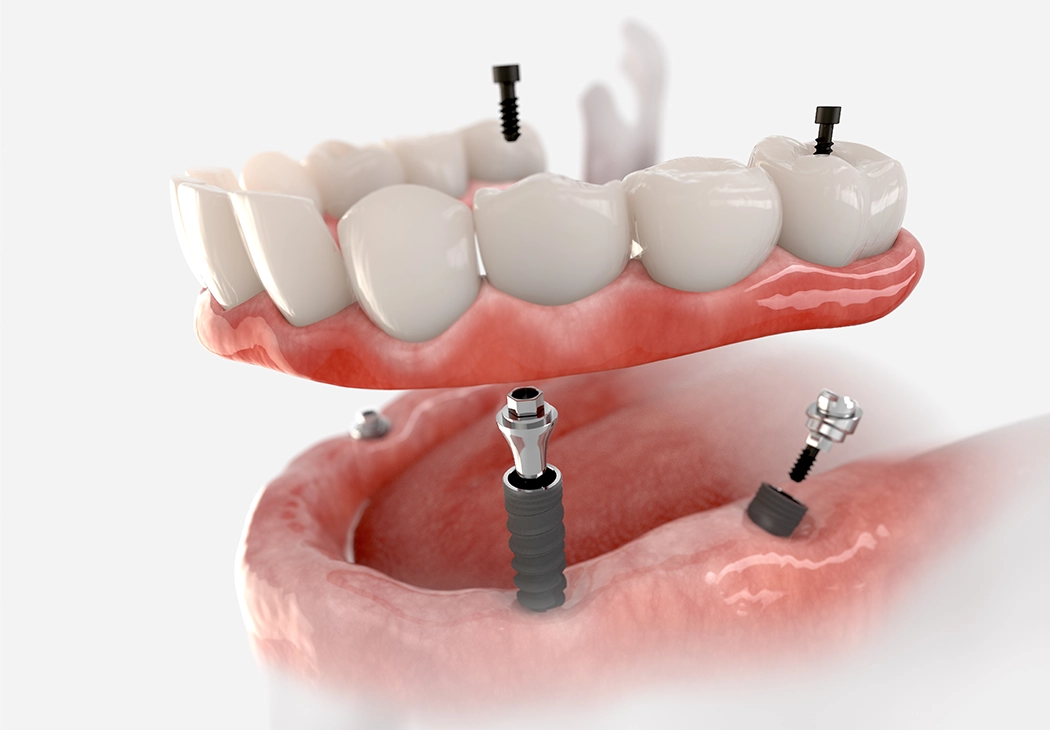 Dantų implantacija