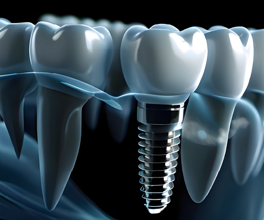 Vieno danties atkūrimas Straumann grupės implantu + nemokama konsultacija