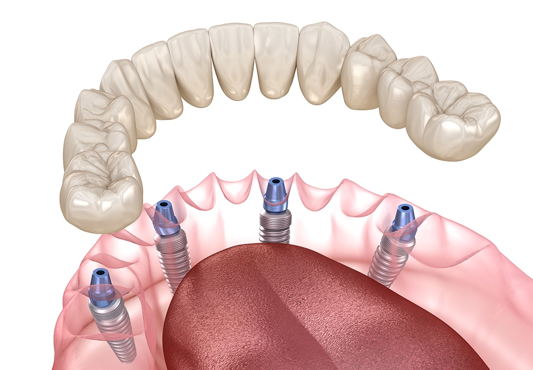 Bedančių žandikaulių gydymas (visi dantys ant 4 arba 6 implantų)